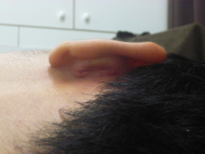 耳介軟骨採取部の傷跡