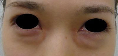 くま治療 経結膜脱脂 浦和第一美容クリニック