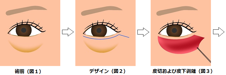 下眼瞼切開の方法１