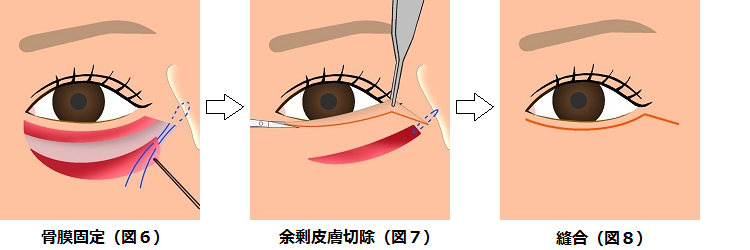 下眼瞼切開の方法３