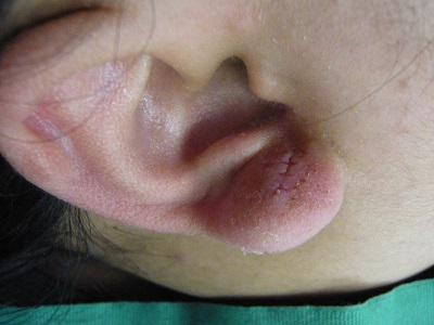 耳たぶ前面ケロイド切除後の傷跡
