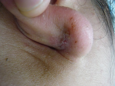 耳たぶ後面ケロイド切除後の傷跡