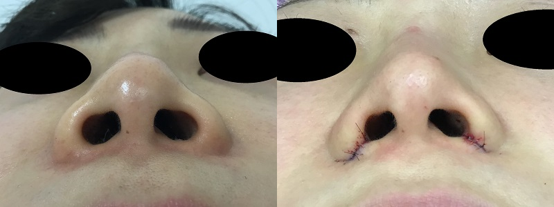 傷跡 小鼻 縮小 小鼻縮小体験談 術後の白い傷跡がコンシーラーを使っても消せない、、