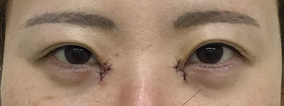 目頭切開  浦和第一美容クリニック