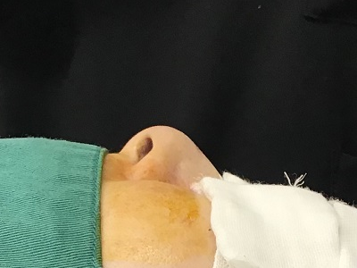 鼻尖部への耳介軟骨移植術前