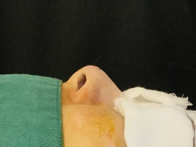 鼻尖部への耳介軟骨移植術後