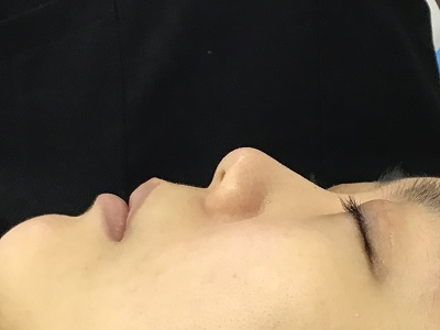 耳介軟骨移植＋鼻プロテーゼ術前