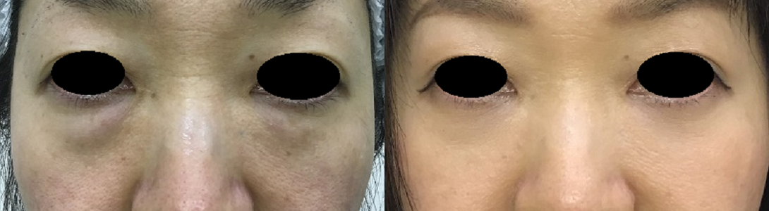 経結膜脱脂+脂肪注入で立体感のある目元にした症例