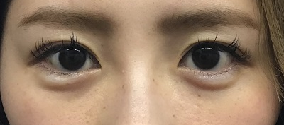 ヒアルロン酸による涙袋形成 浦和第一美容クリニック