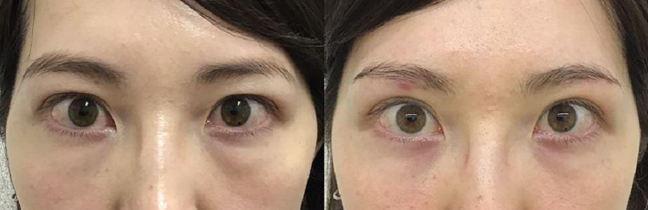 「眉下切開+経結膜脱脂」により目元をすっきりさせた症例