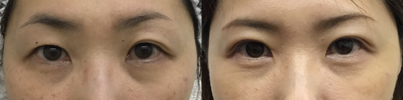 左右差のある二重まぶた 浦和第一美容クリニック