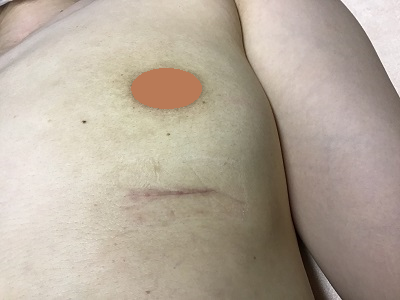 術後１ヶ月目の傷跡