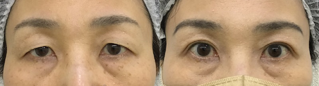 埋没ループ4点法