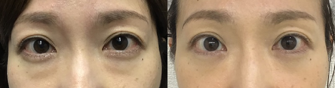 経結膜脱脂で目元の印象を明るくした症例