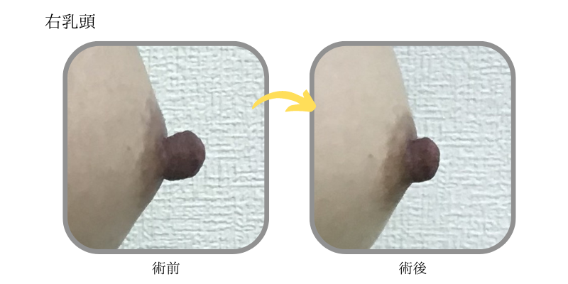 右乳頭before&after