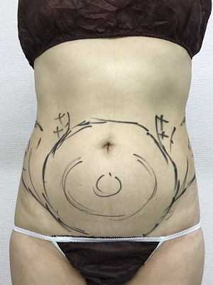 下腹部の脂肪吸引術前デザイン
