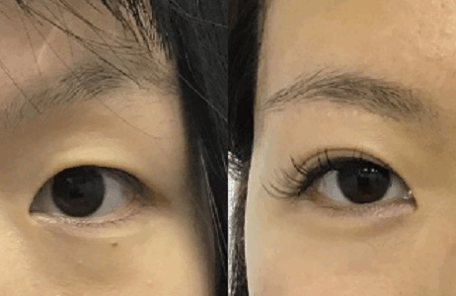 眉下切開＋埋没法