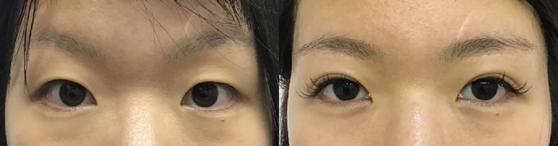 眉下切開＋埋没法