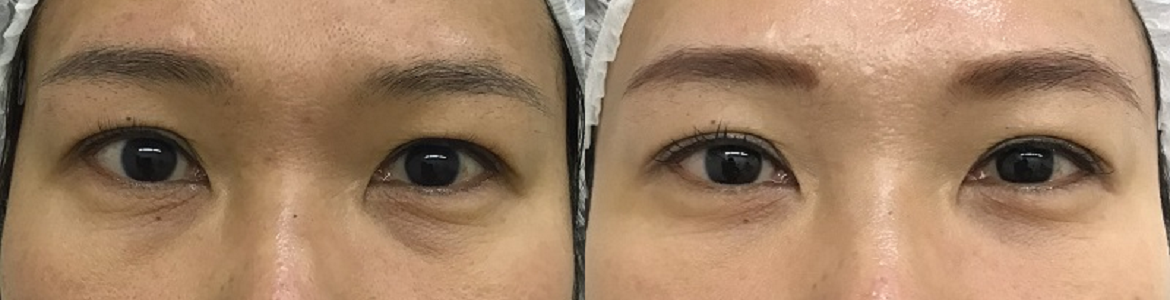 経結膜脱脂により影クマを改善した症例