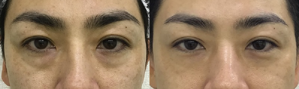 男性のクマ治療(経結膜脱脂)症例