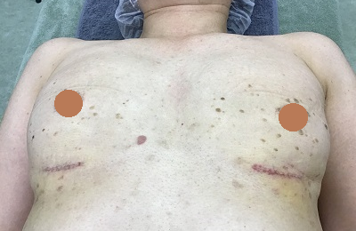 術後１週間臥位