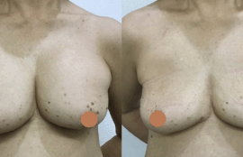 シリコンバッグ抜去