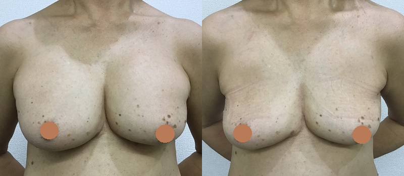 シリコンバッグ抜去