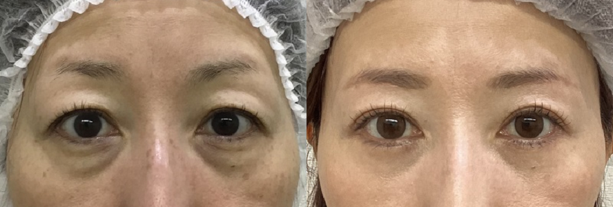 blepharoplasty