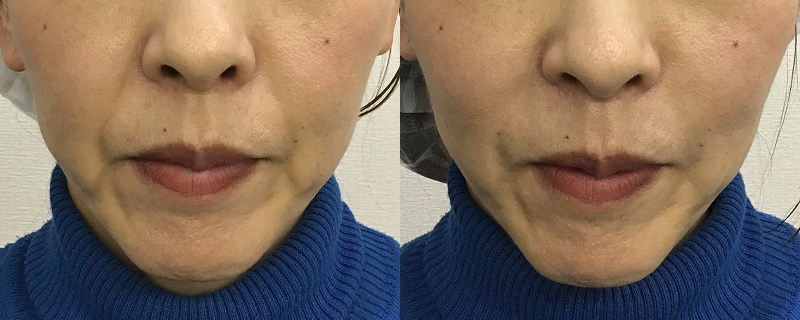 法令線へのヒアルロン酸注射