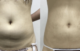 下腹部の脂肪吸引
