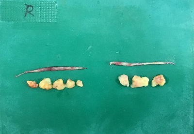 切除した皮膚と眼窩脂肪