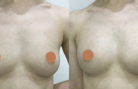 脂肪注入による豊胸術