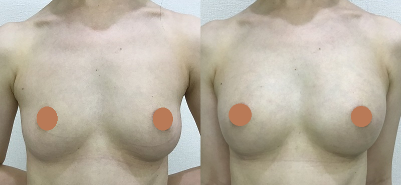 脂肪注入による豊胸術