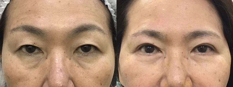 眉下切開＋埋没法＋下眼瞼切開＋スレッドリフト