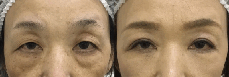 埋没法＋下眼瞼切開（目の下たるみ取り＋脱脂）