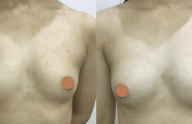 脂肪注入による豊胸術