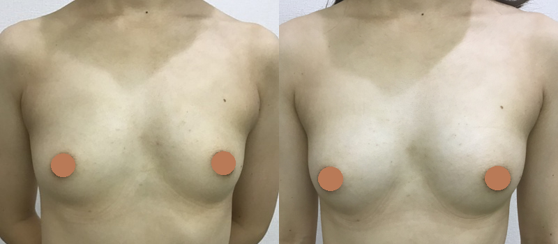 脂肪注入による豊胸術