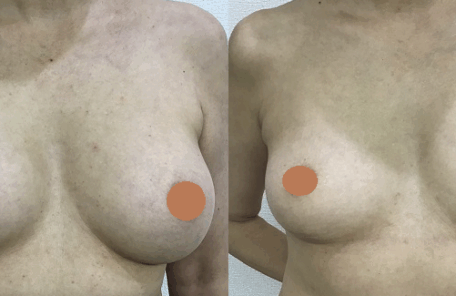 生食バッグ抜去