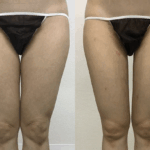 大腿内側の脂肪吸引