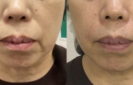 ハイフ＋法令線へのヒアルロン酸注射