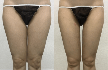 大腿内側の脂肪吸引