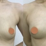 脂肪注入による豊胸術