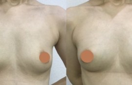 脂肪注入による豊胸術