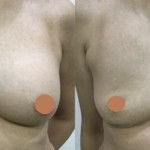 生食バッグ抜去