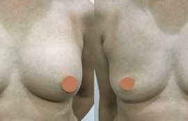 生食バッグ抜去