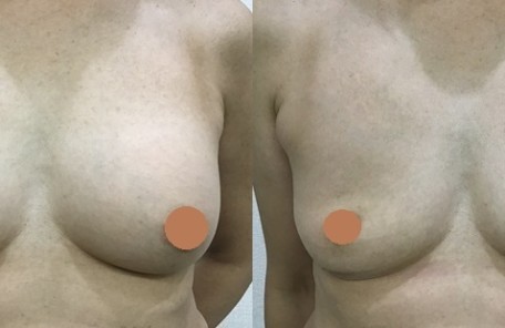 生食バッグ抜去