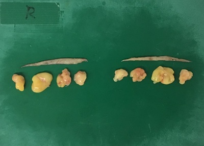 切除した皮膚と眼窩脂肪