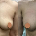 脂肪注入による豊胸術