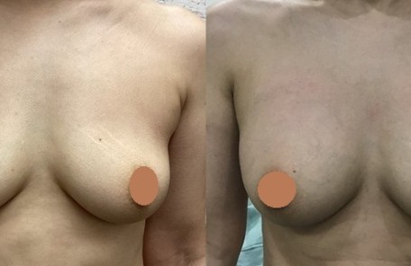 脂肪注入による豊胸術