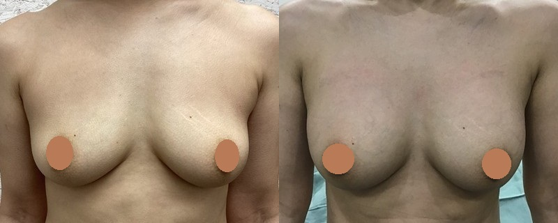 脂肪注入による豊胸術